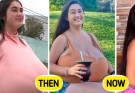 She Tried on Eight Shirts, but None Fit: Brazilian Student’s Rare Medical Condition Led to a Life-Changing 10-Hour Surgery
